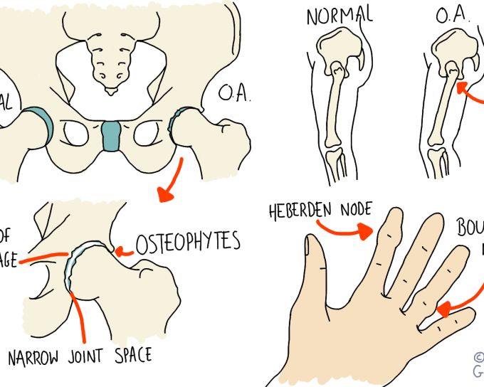 Hip and Knee Osteoarthritis